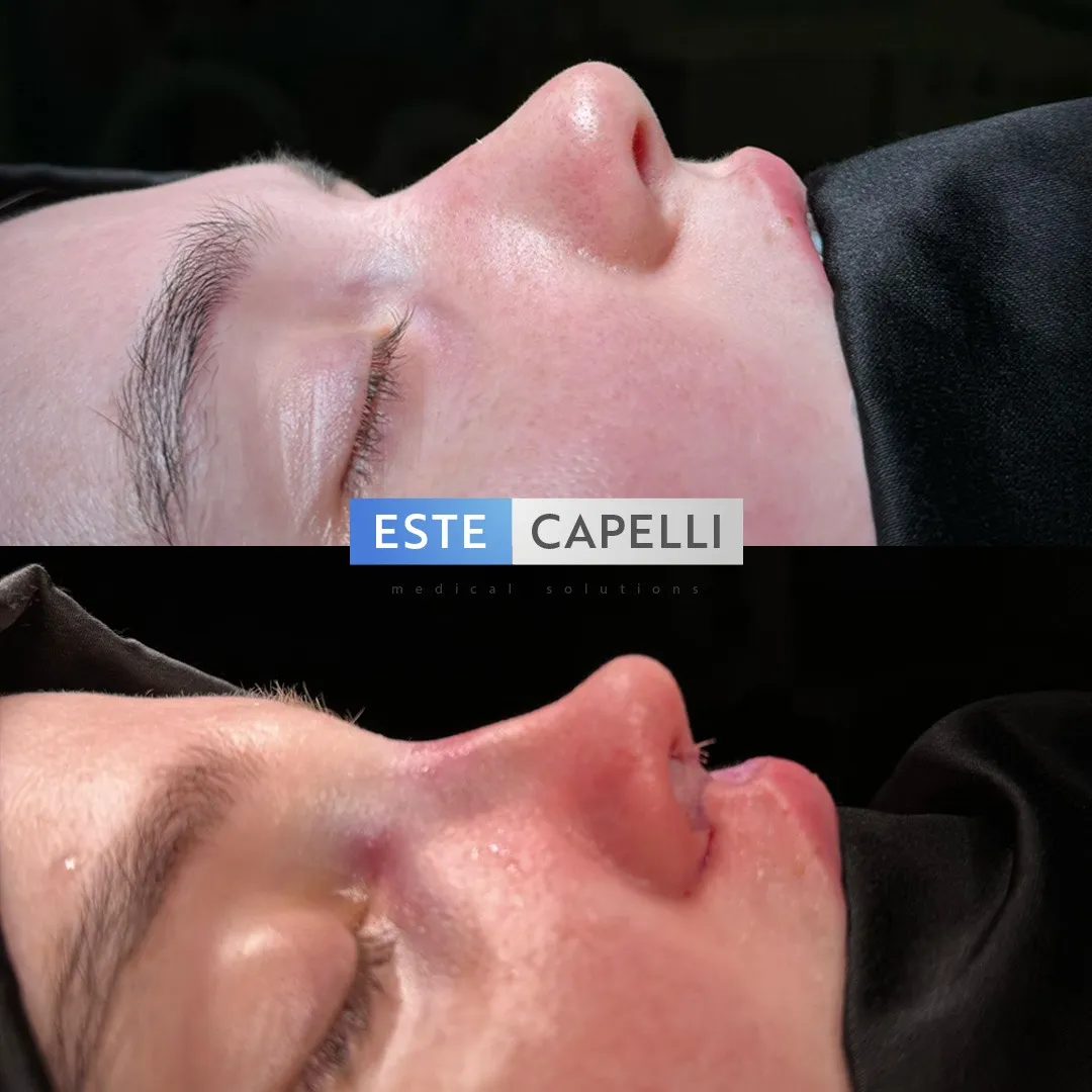 Before and after result