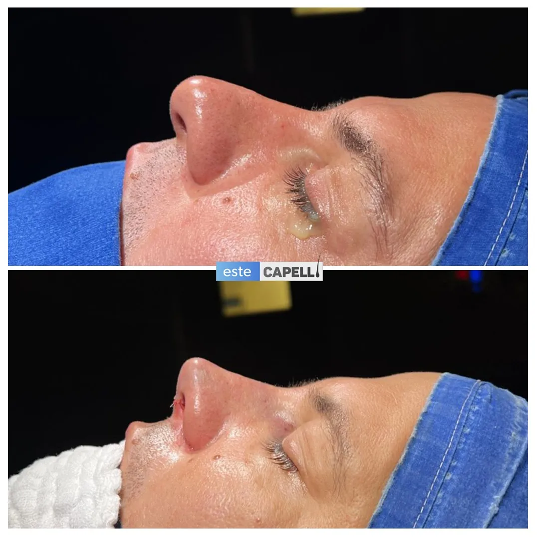 Before and after result