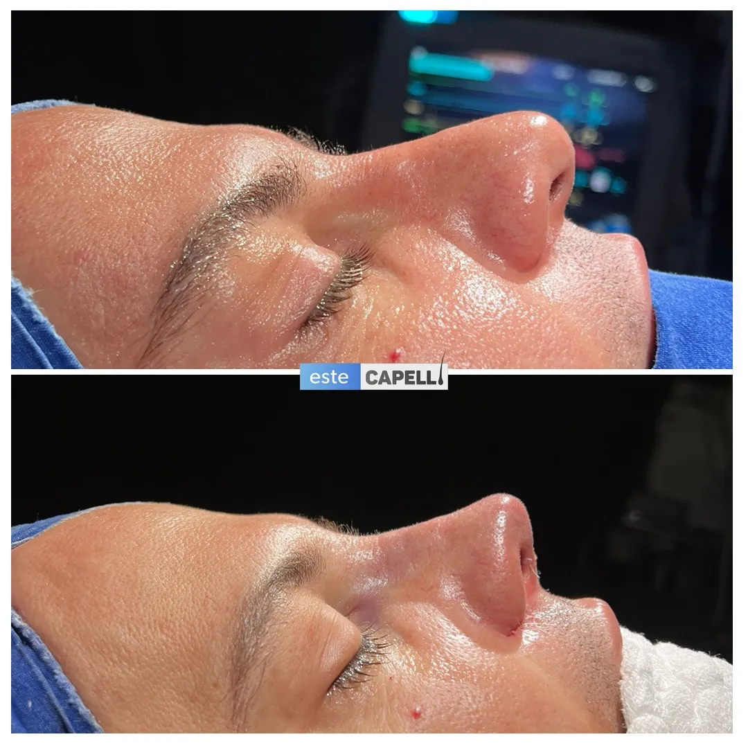 Before and after result