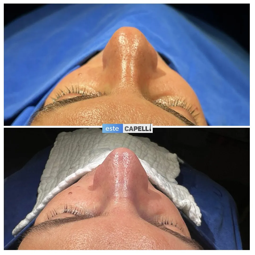 Before and after result