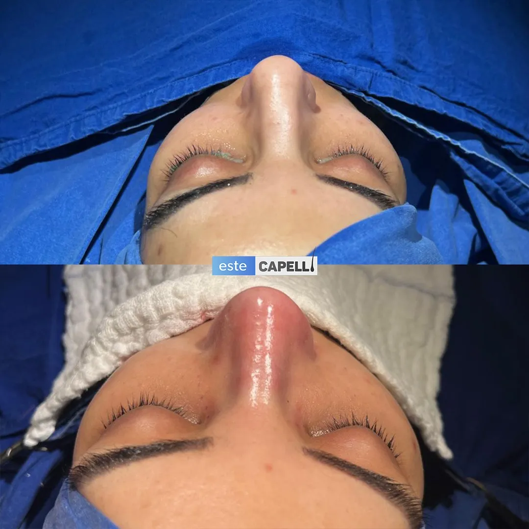 Before and after result
