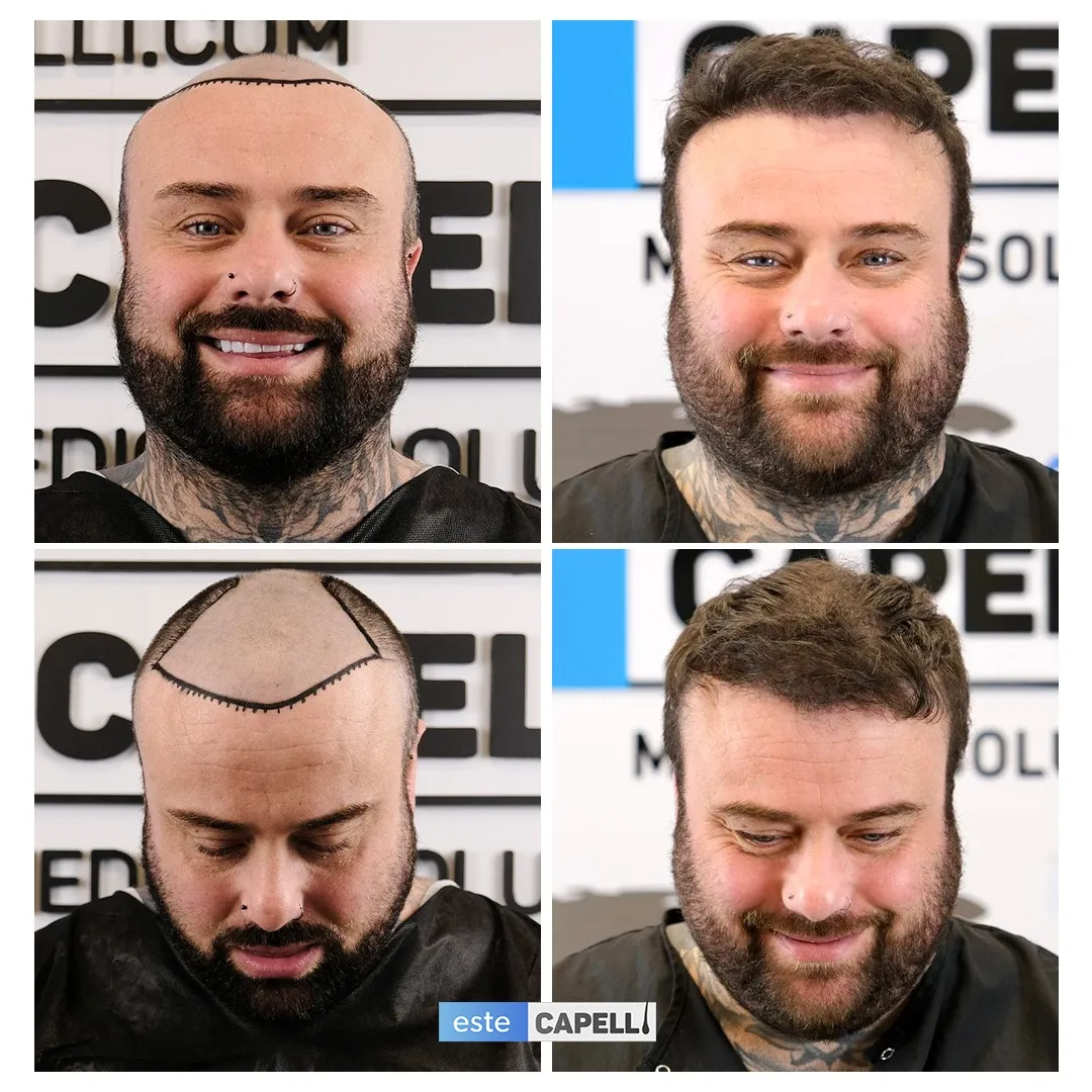 Before and after result