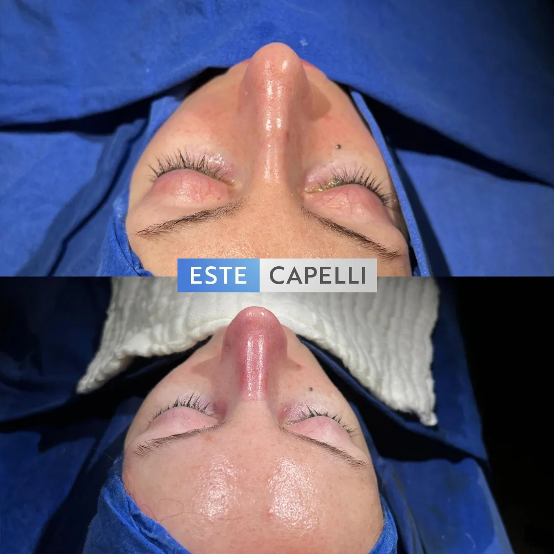 Before and after result