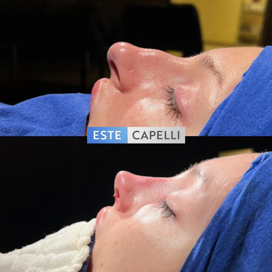Before and after result