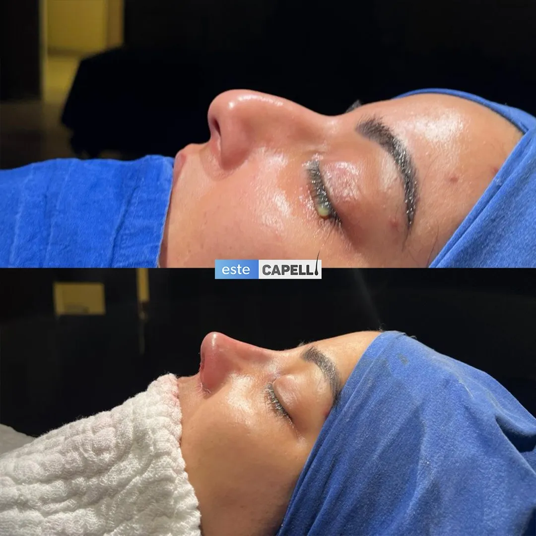 Before and after result