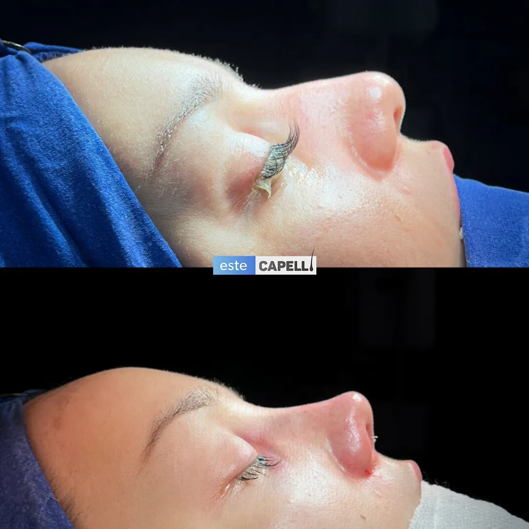 Before and after result