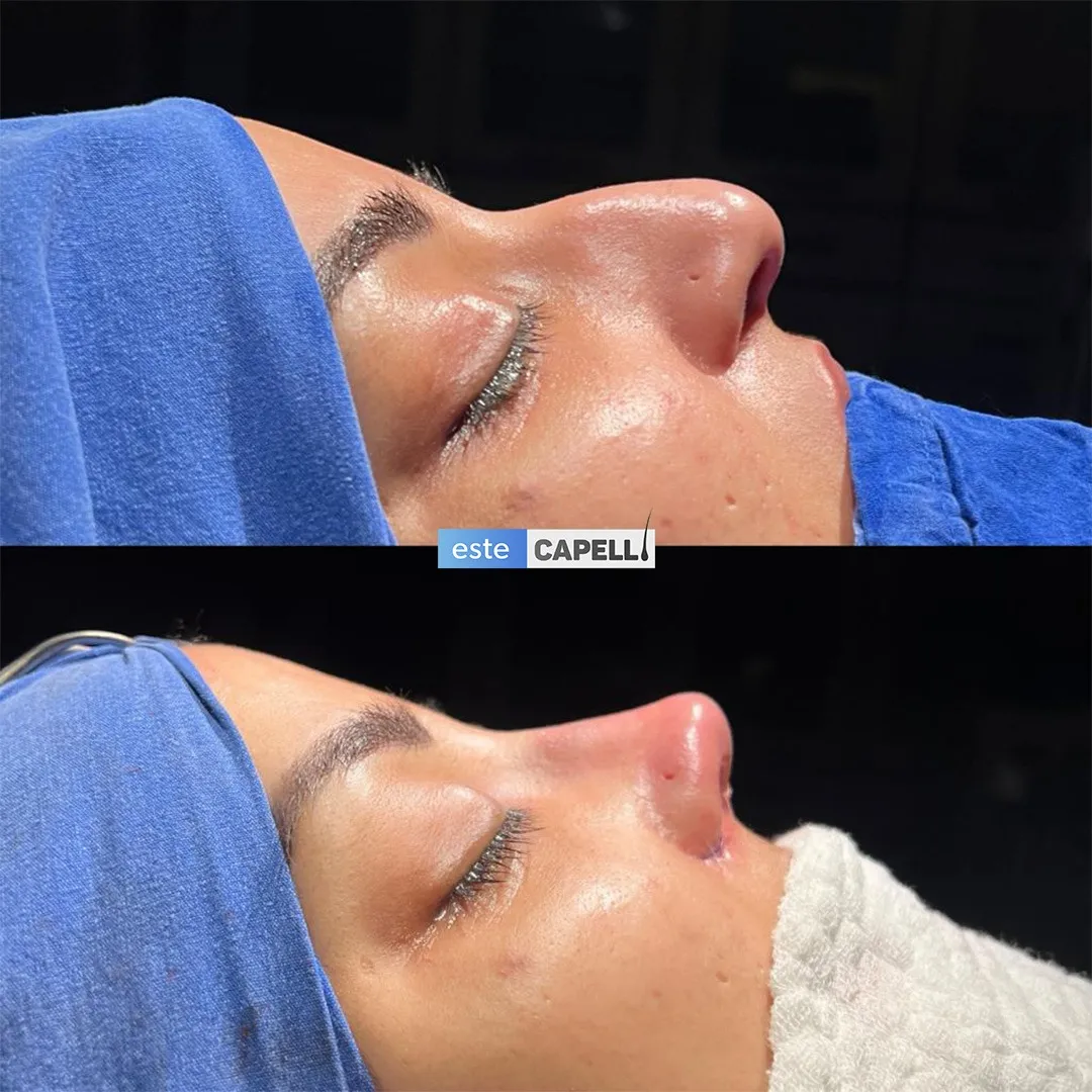 Before and after result