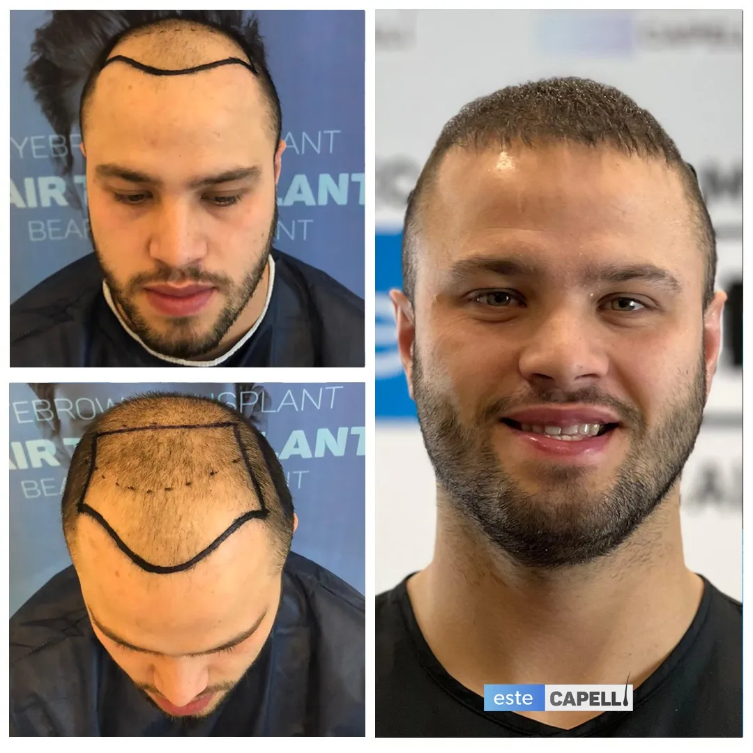 Before and after result