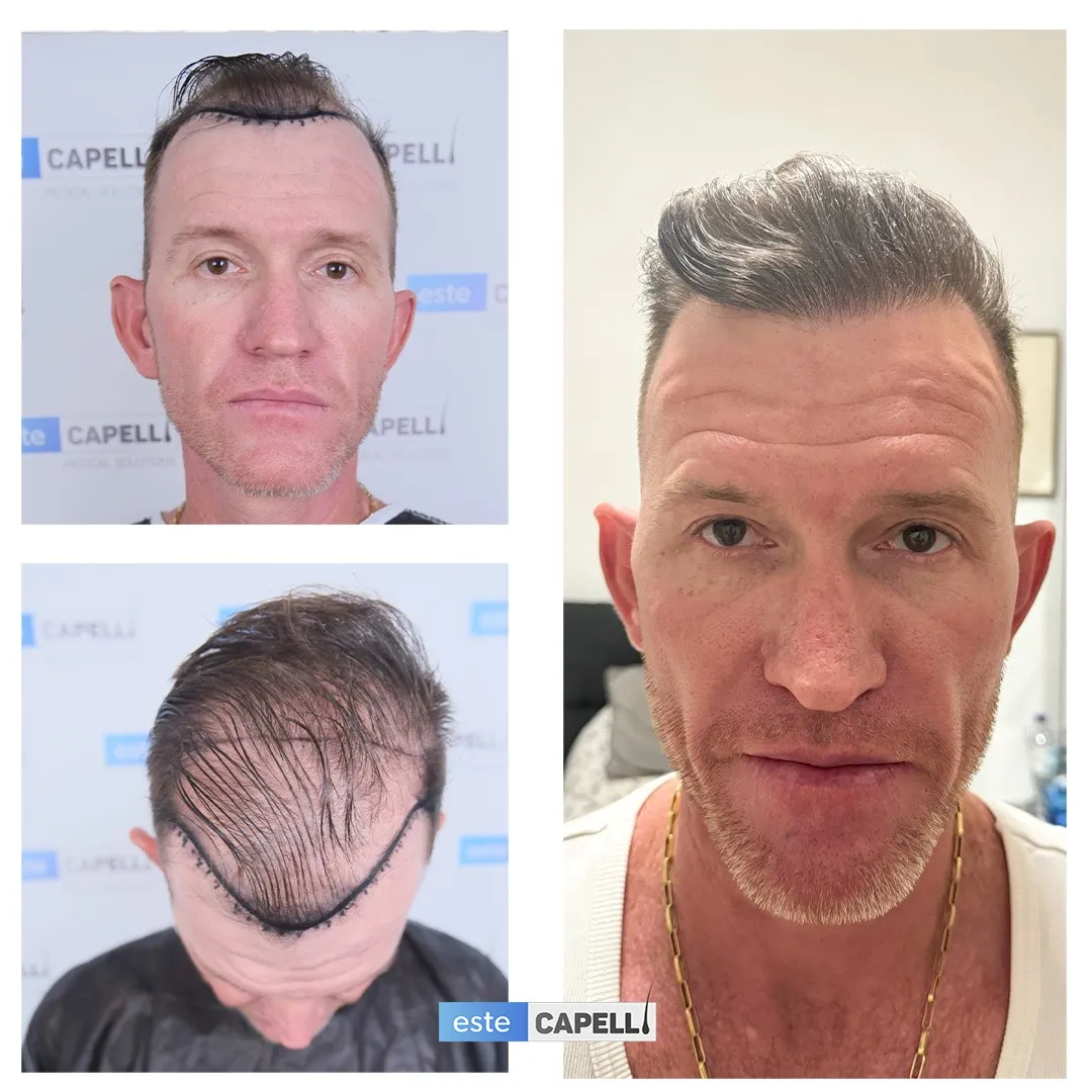 Before and after result