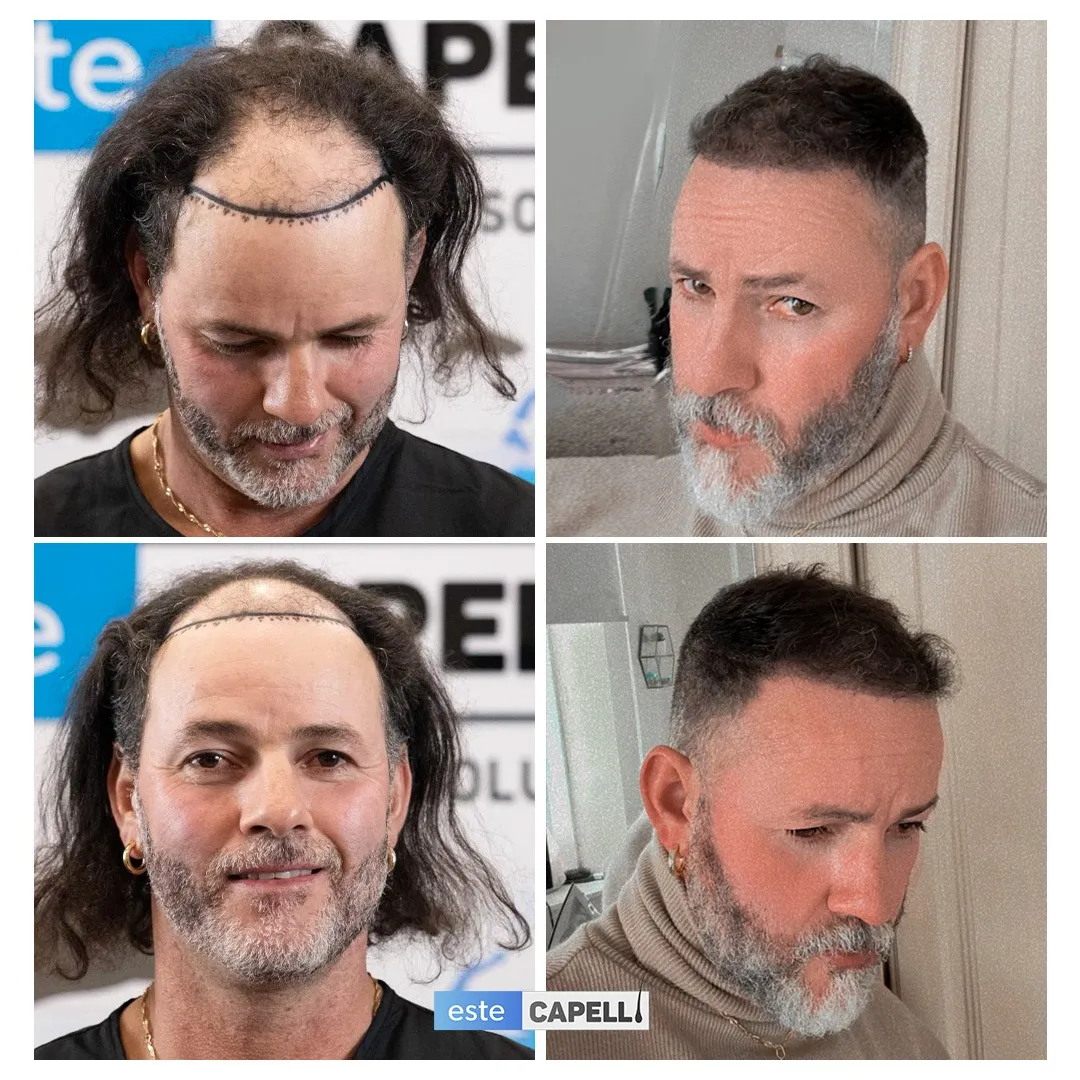 Before and after result