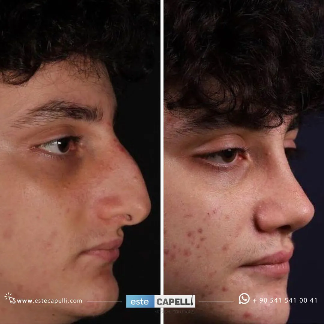 Before and after result