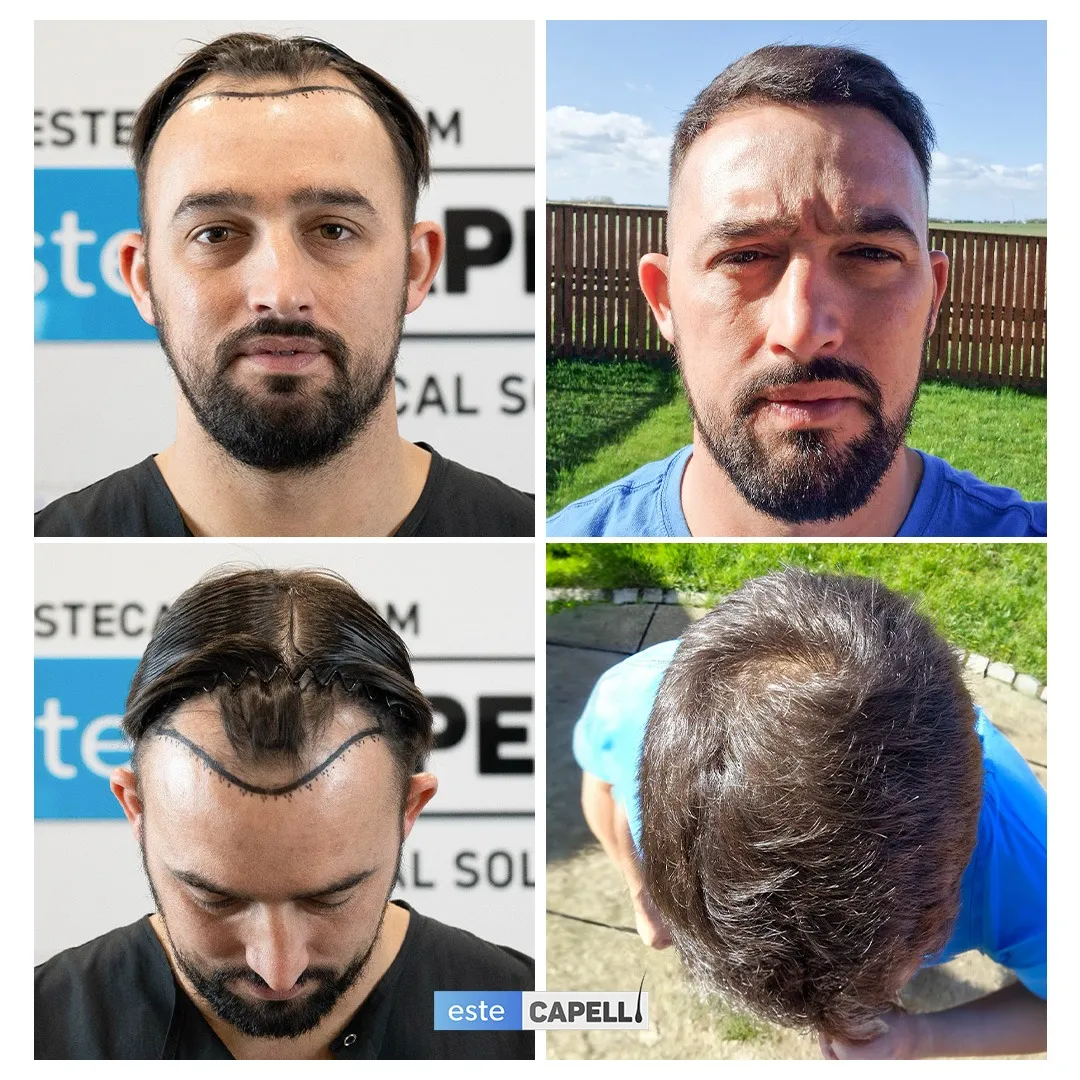 Before and after result