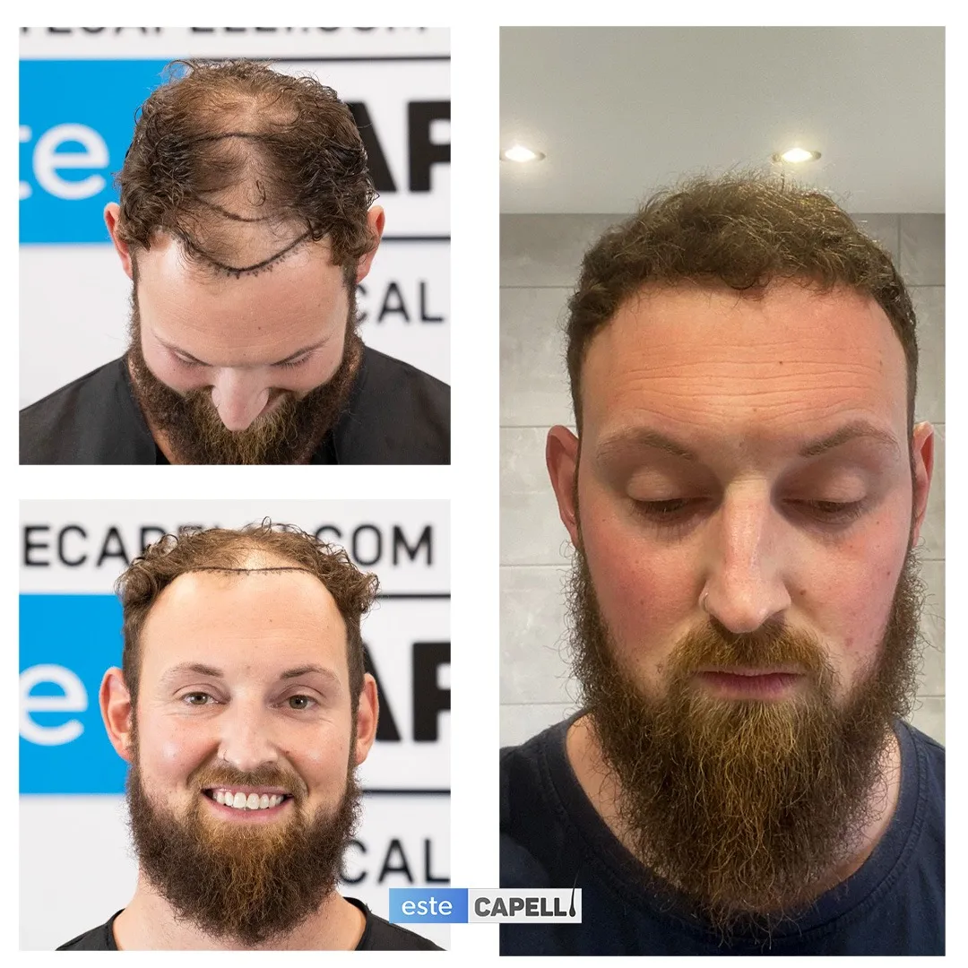Before and after result