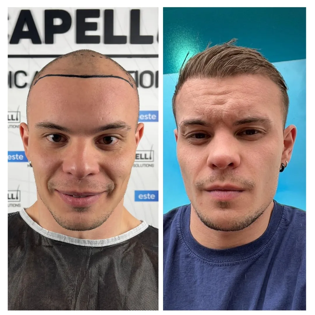 Before and after result