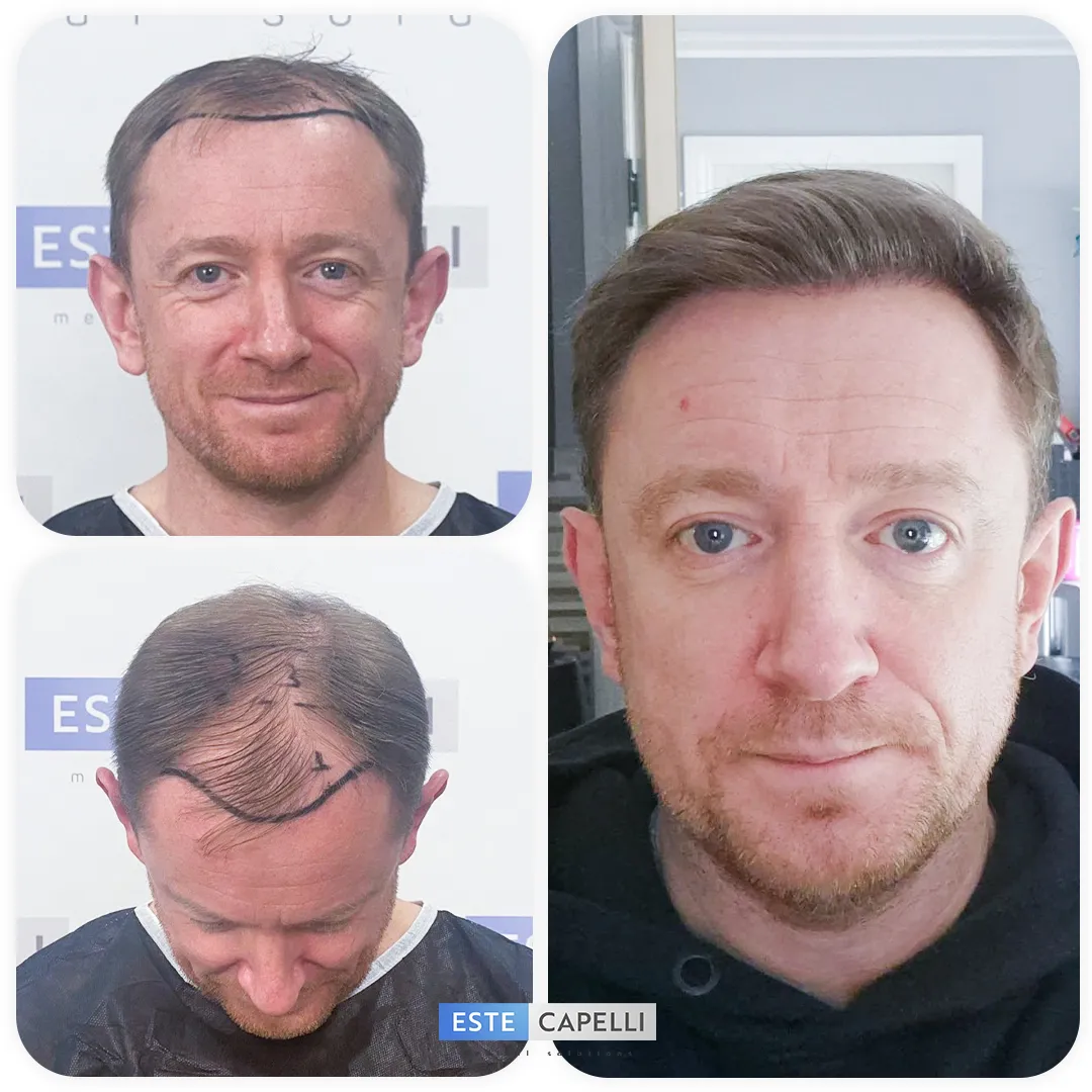 Before and after result