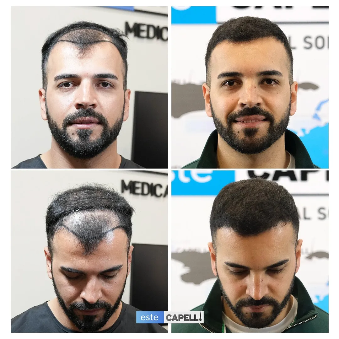 Before and after result