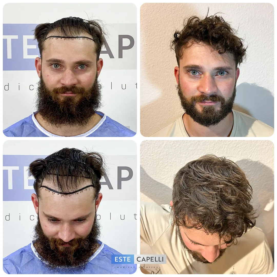Before and after result