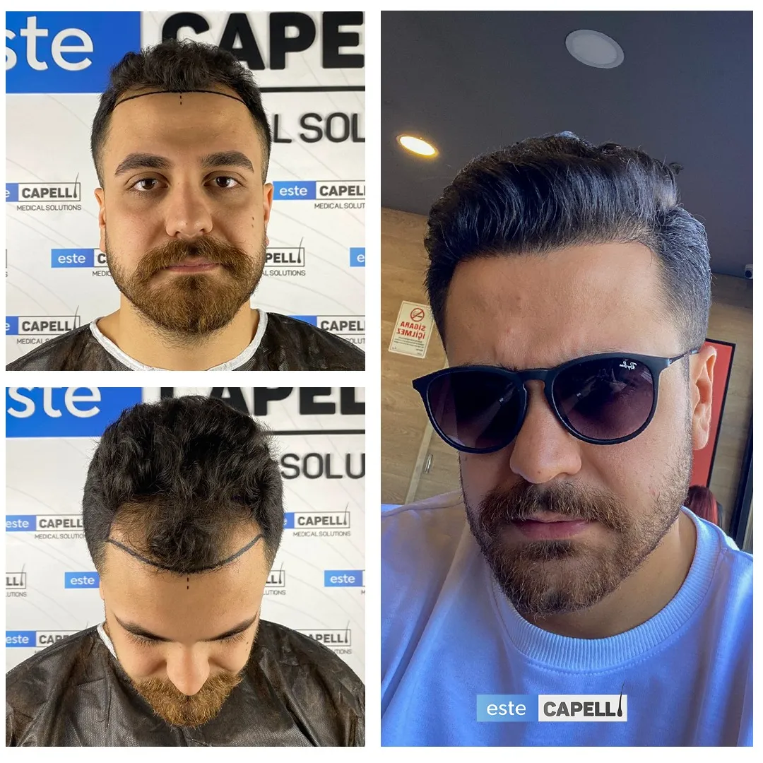 Before and after result