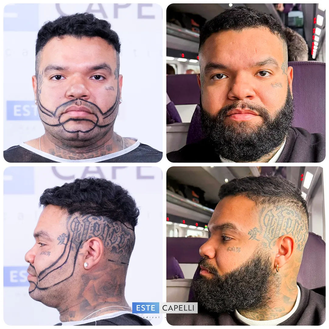 Before and after result