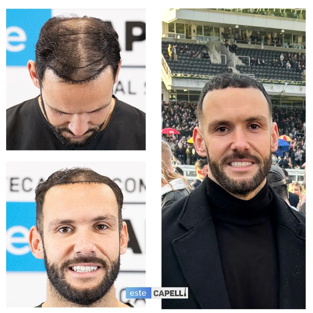 Before and after result