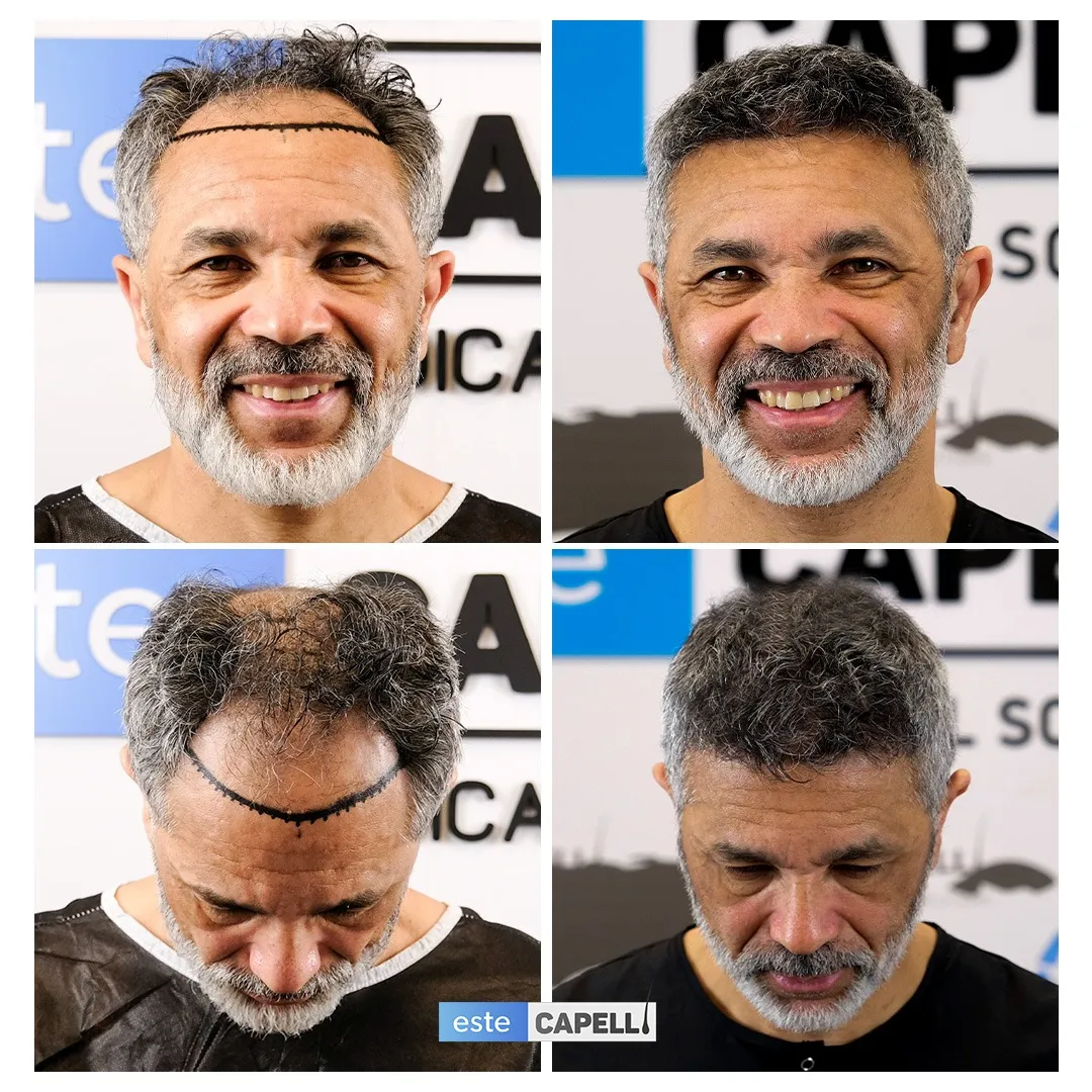 Before and after result