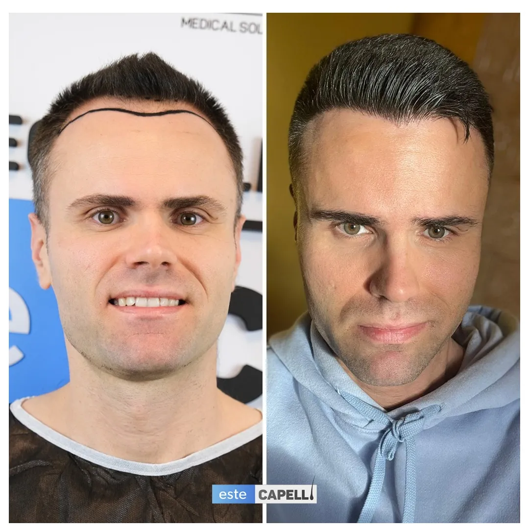 Before and after result