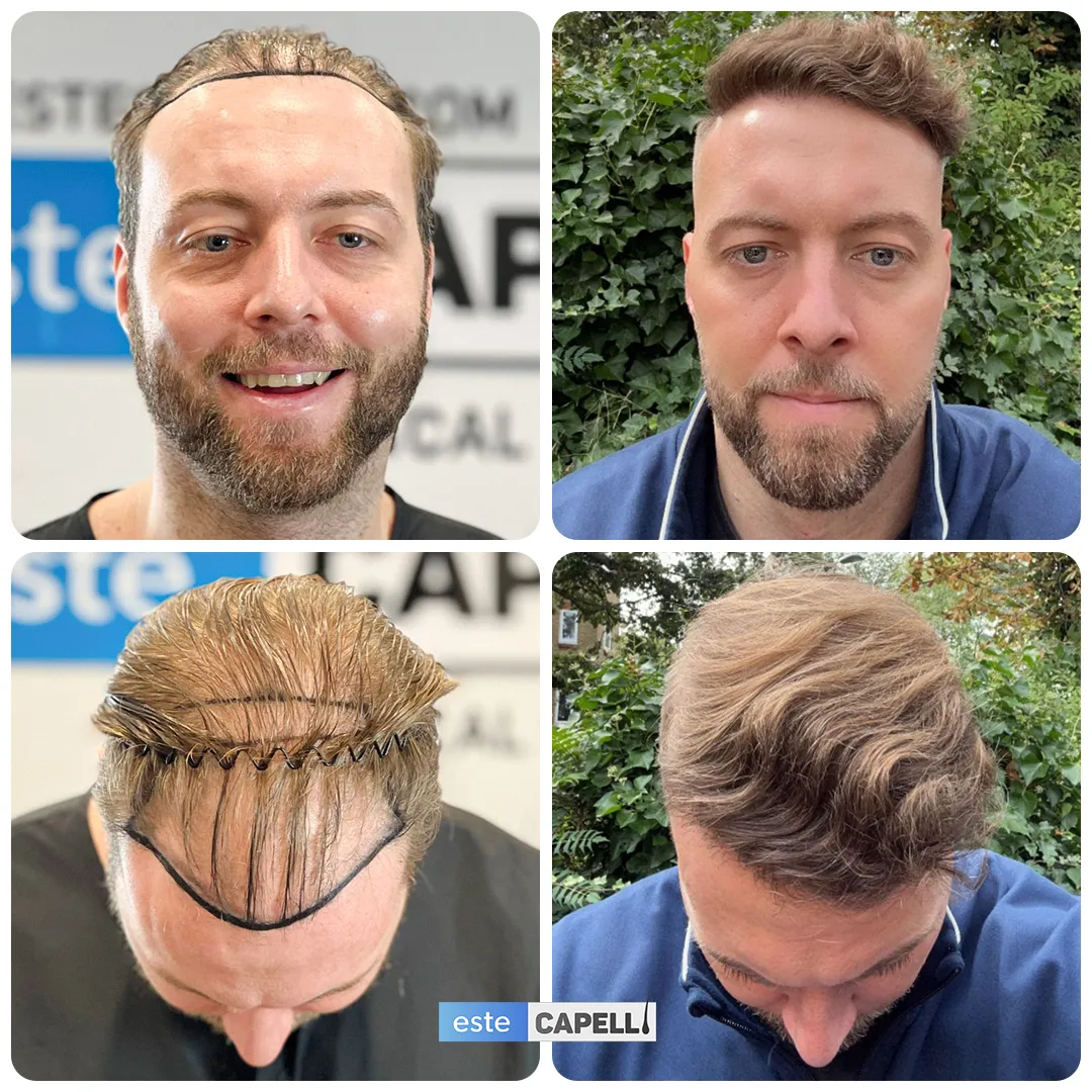 Before and after result