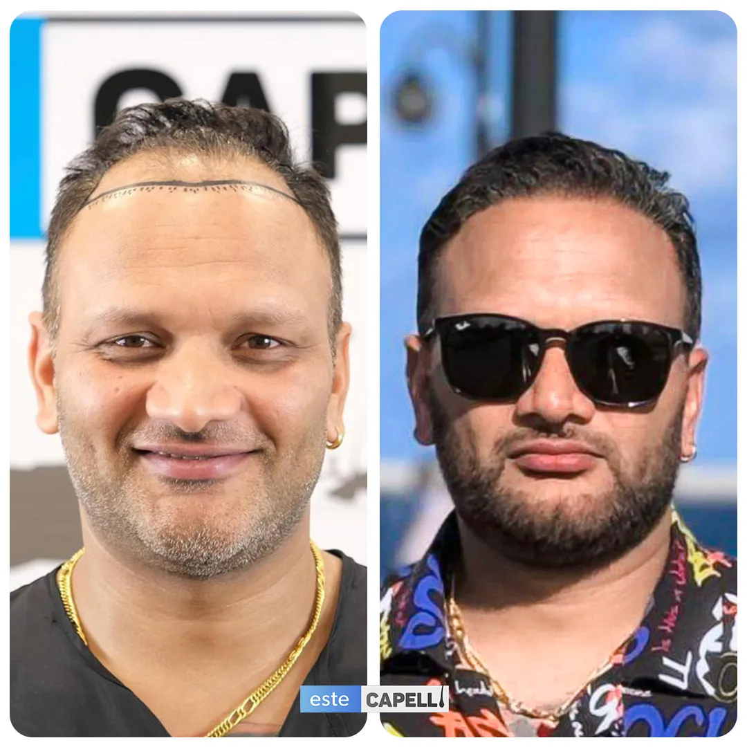 Before and after result