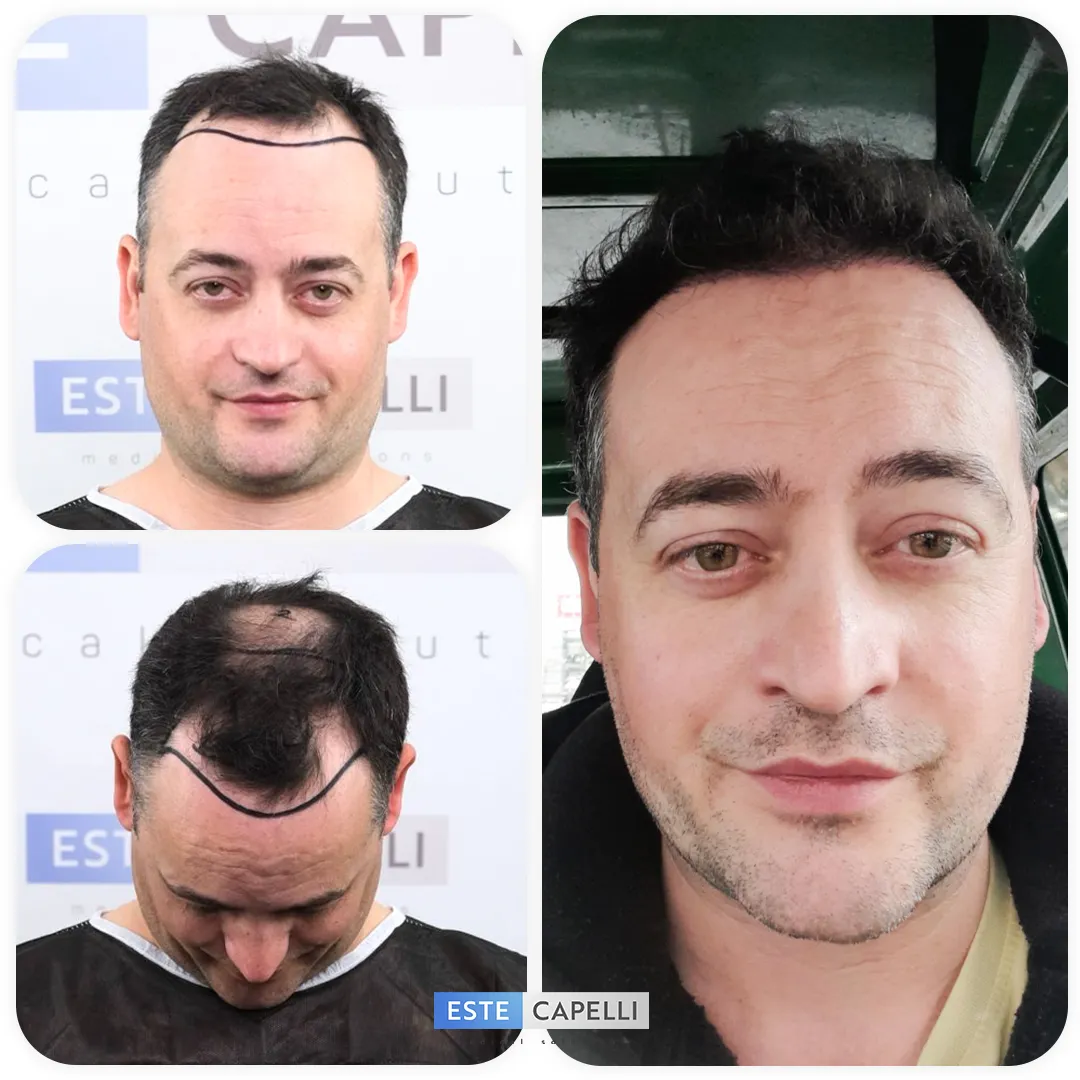 Before and after result