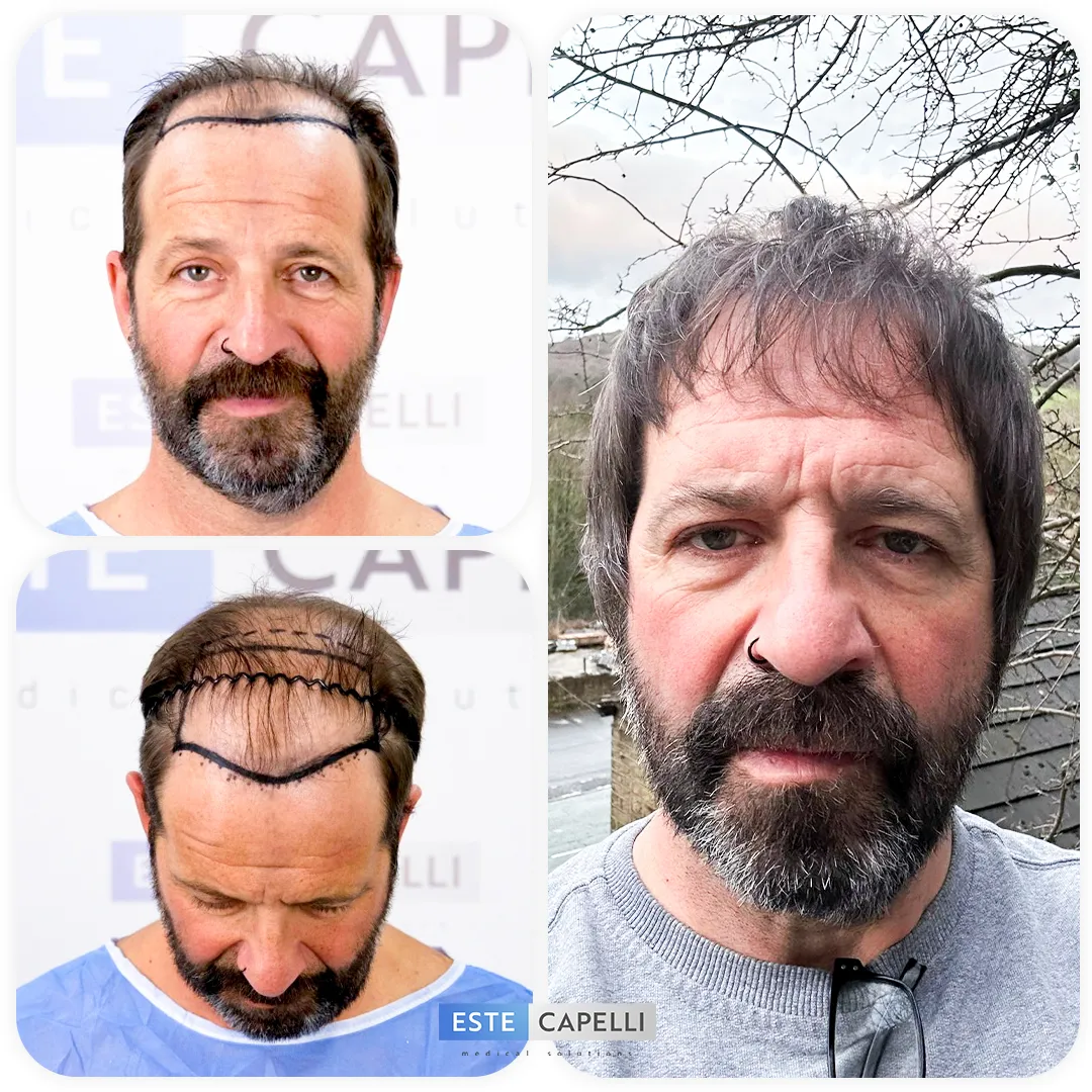 Before and after result