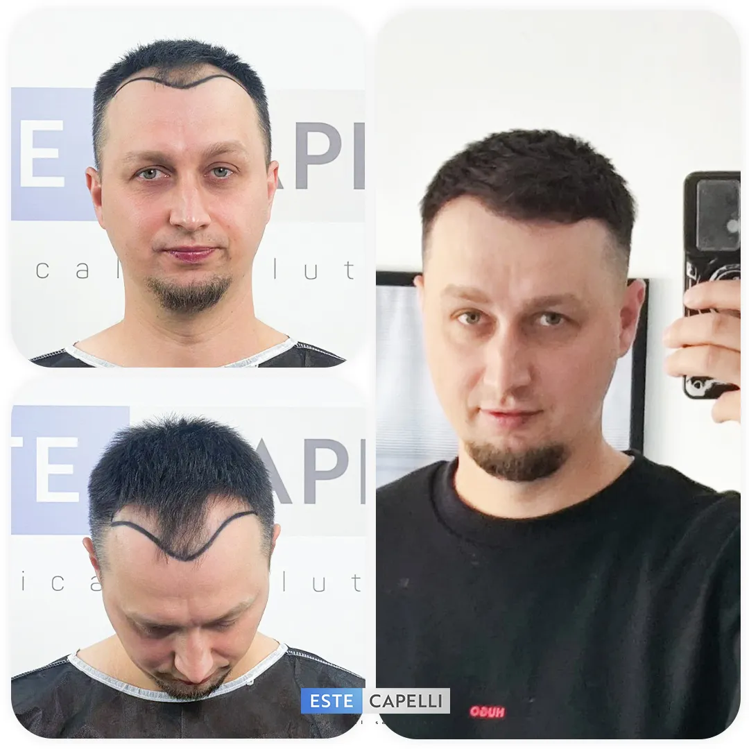 Before and after result