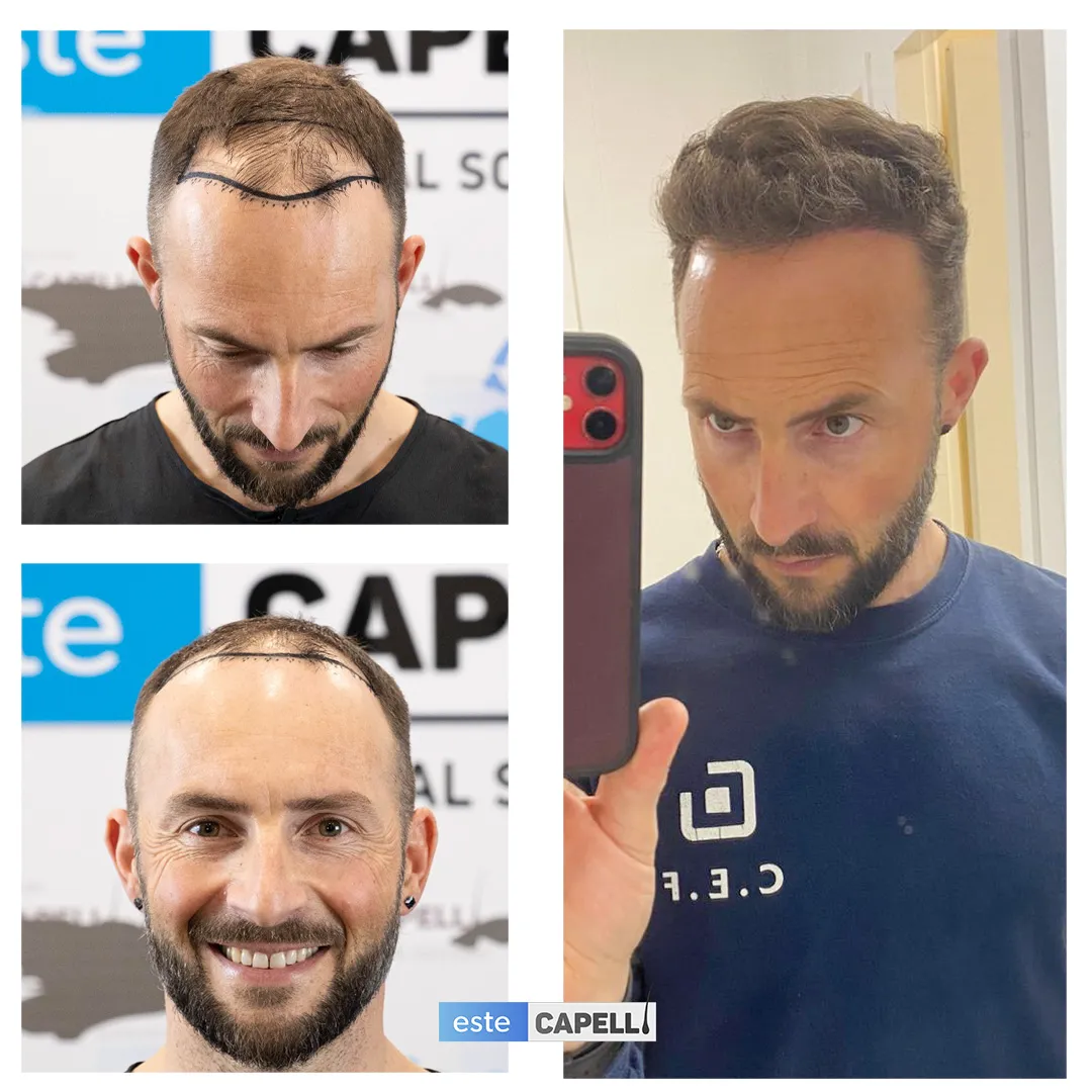Before and after result