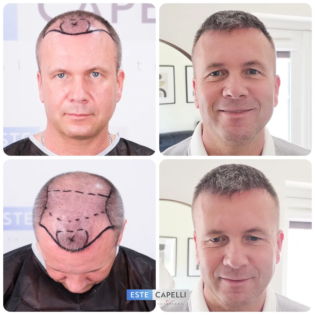 Before and after result