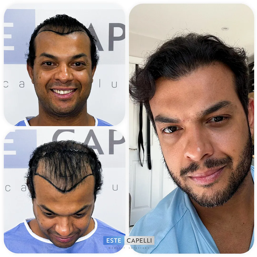 Before and after result
