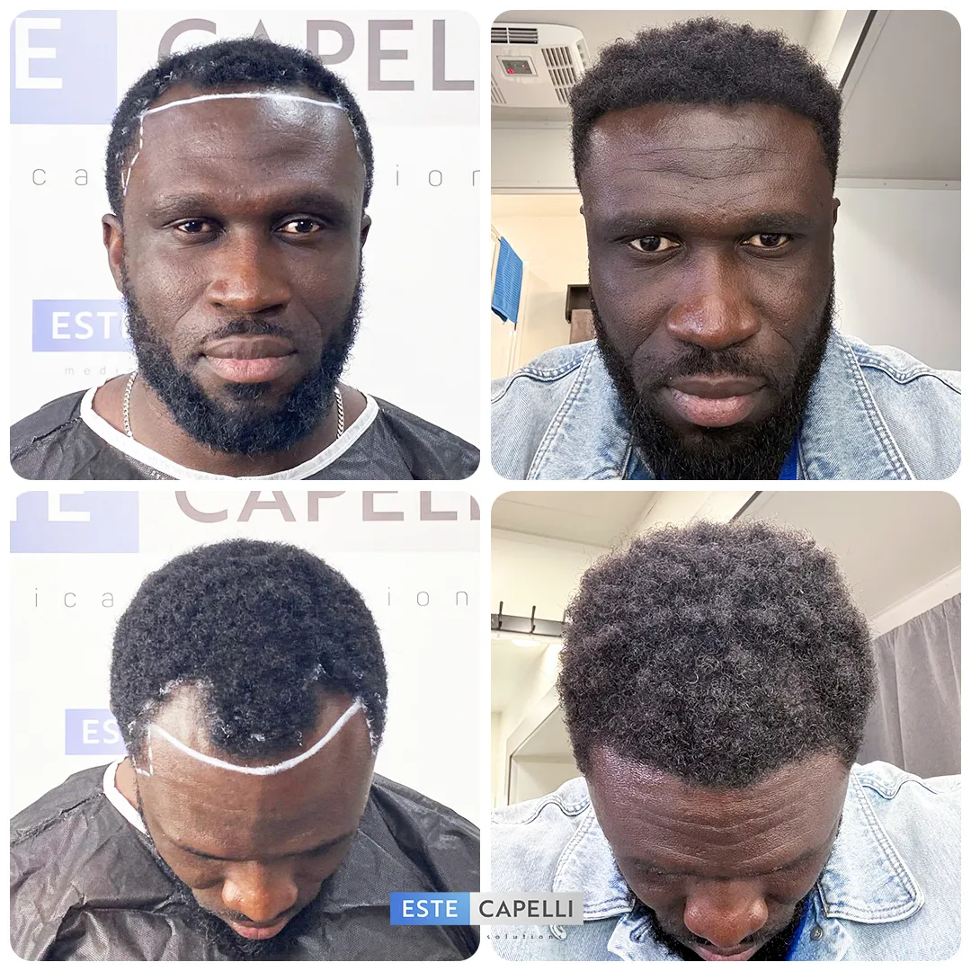 Before and after result