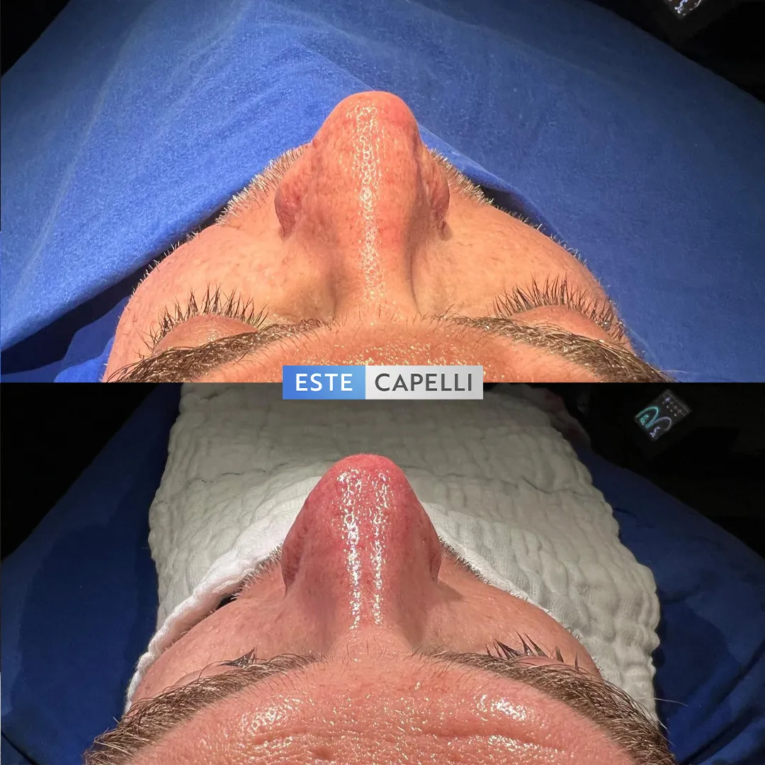 Before and after result