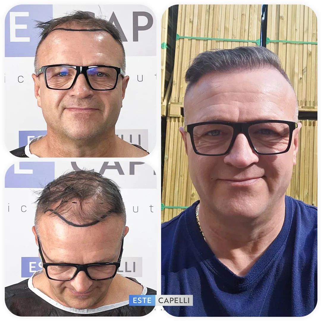 Before and after result
