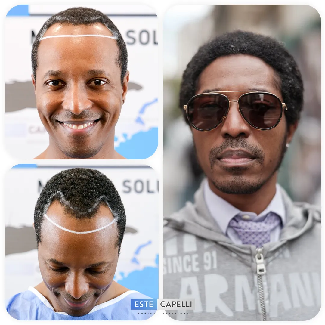 Before and after result
