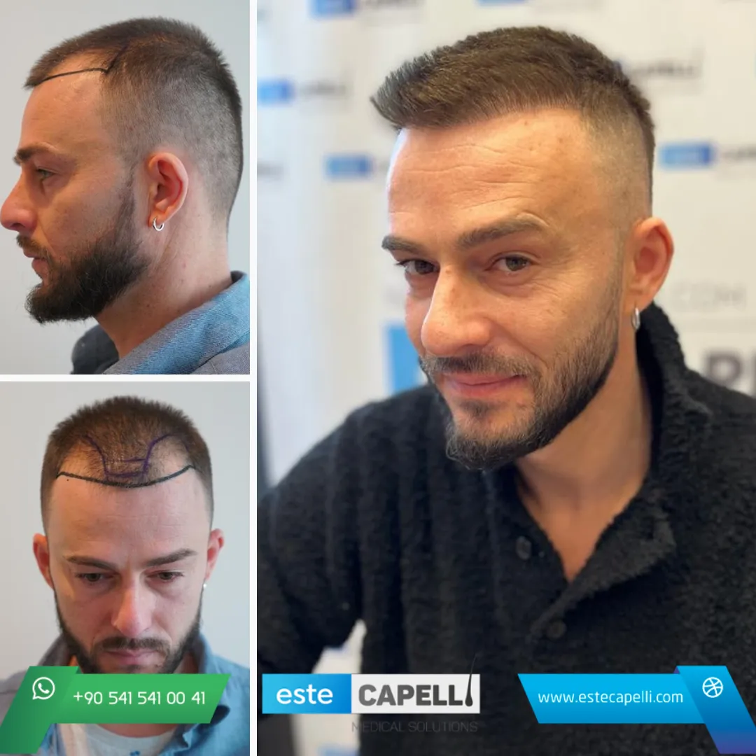 Before and after result