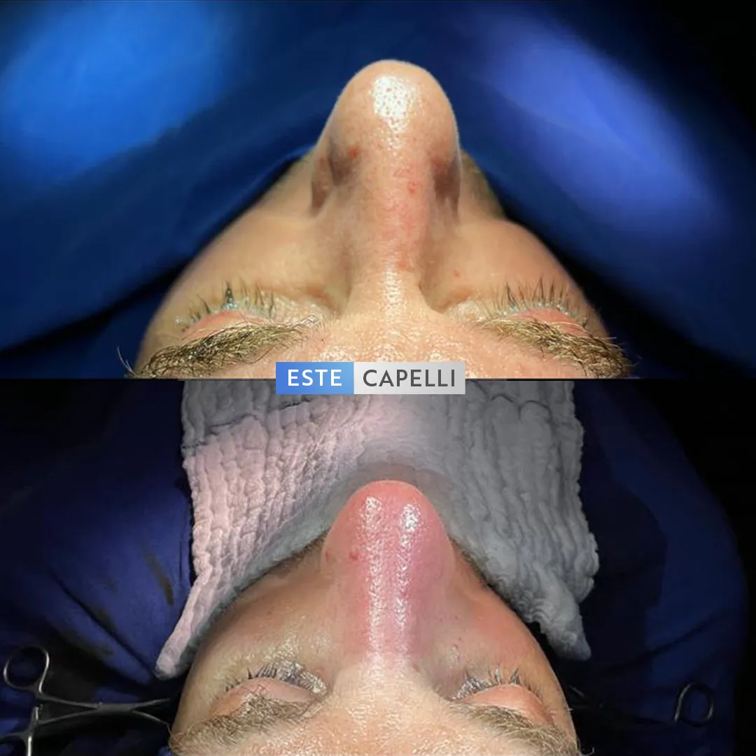 Before and after result