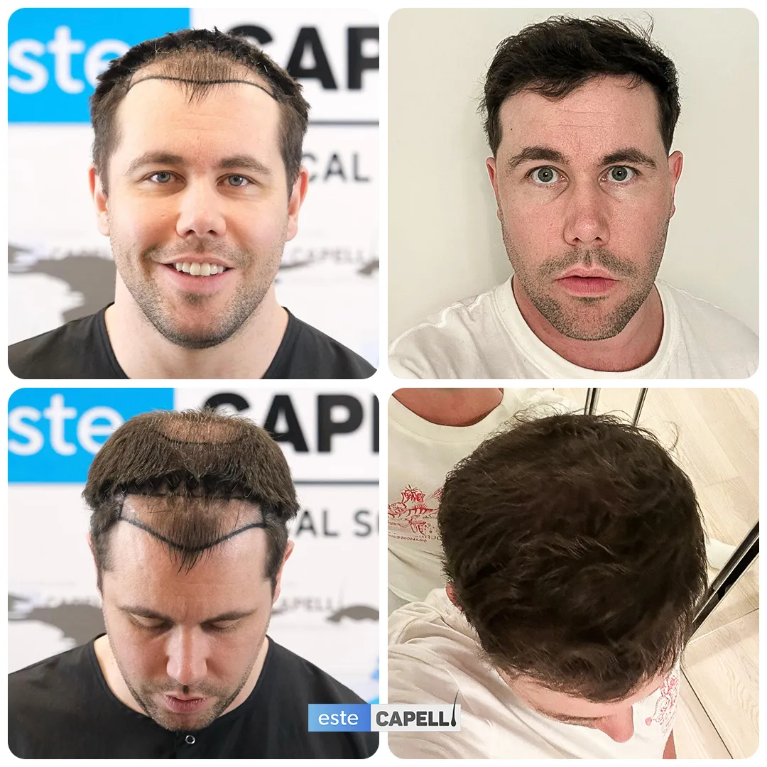 Before and after result