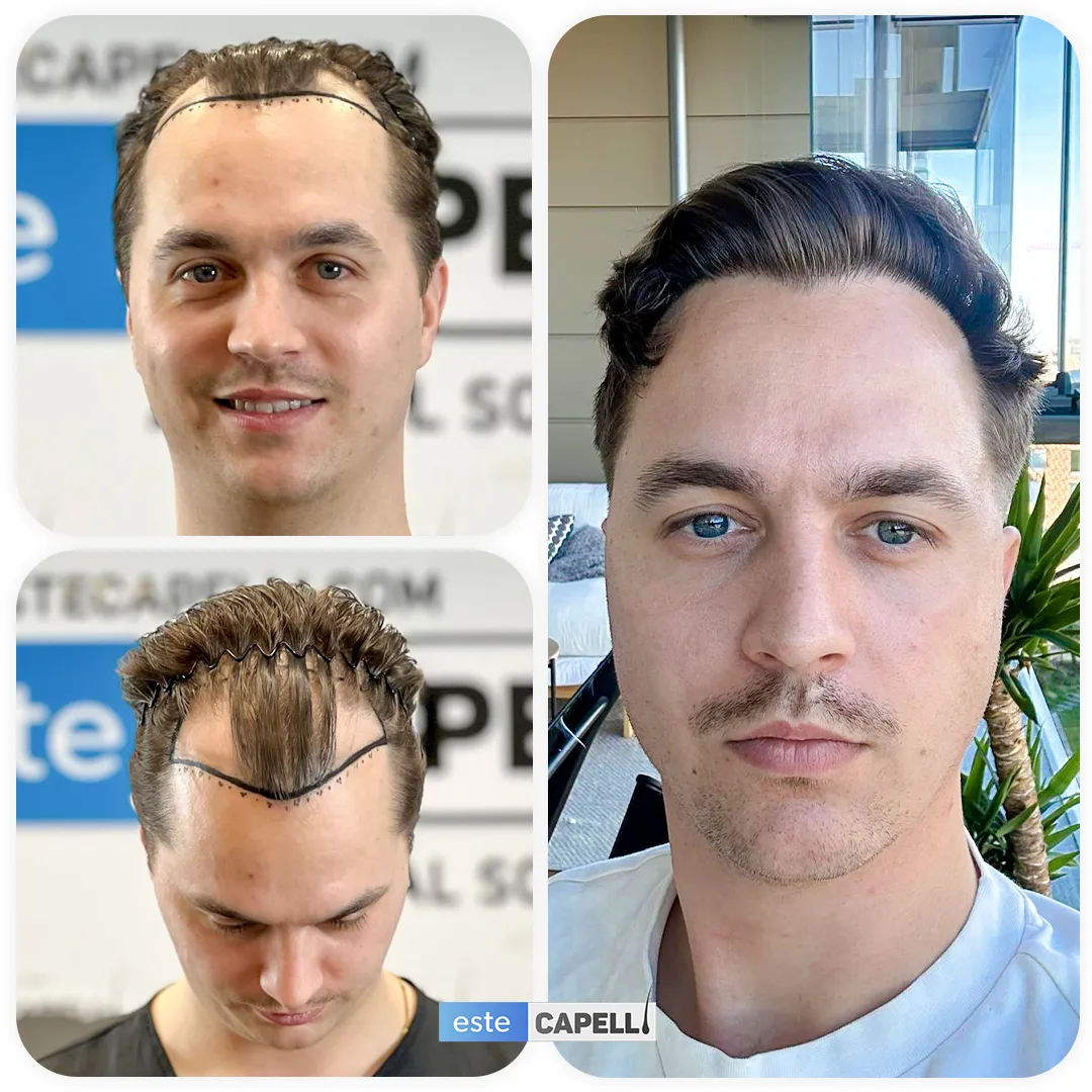 Before and after result