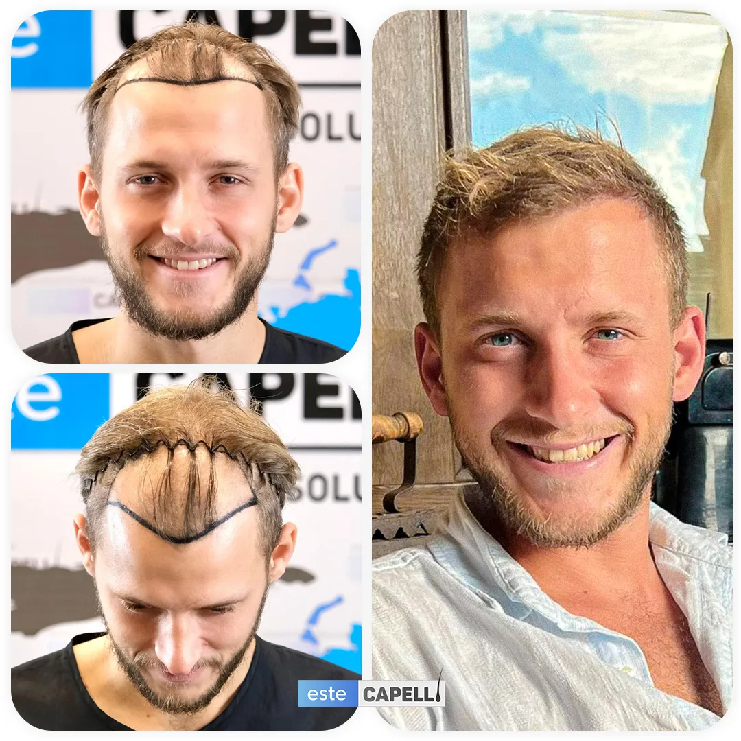 Before and after result