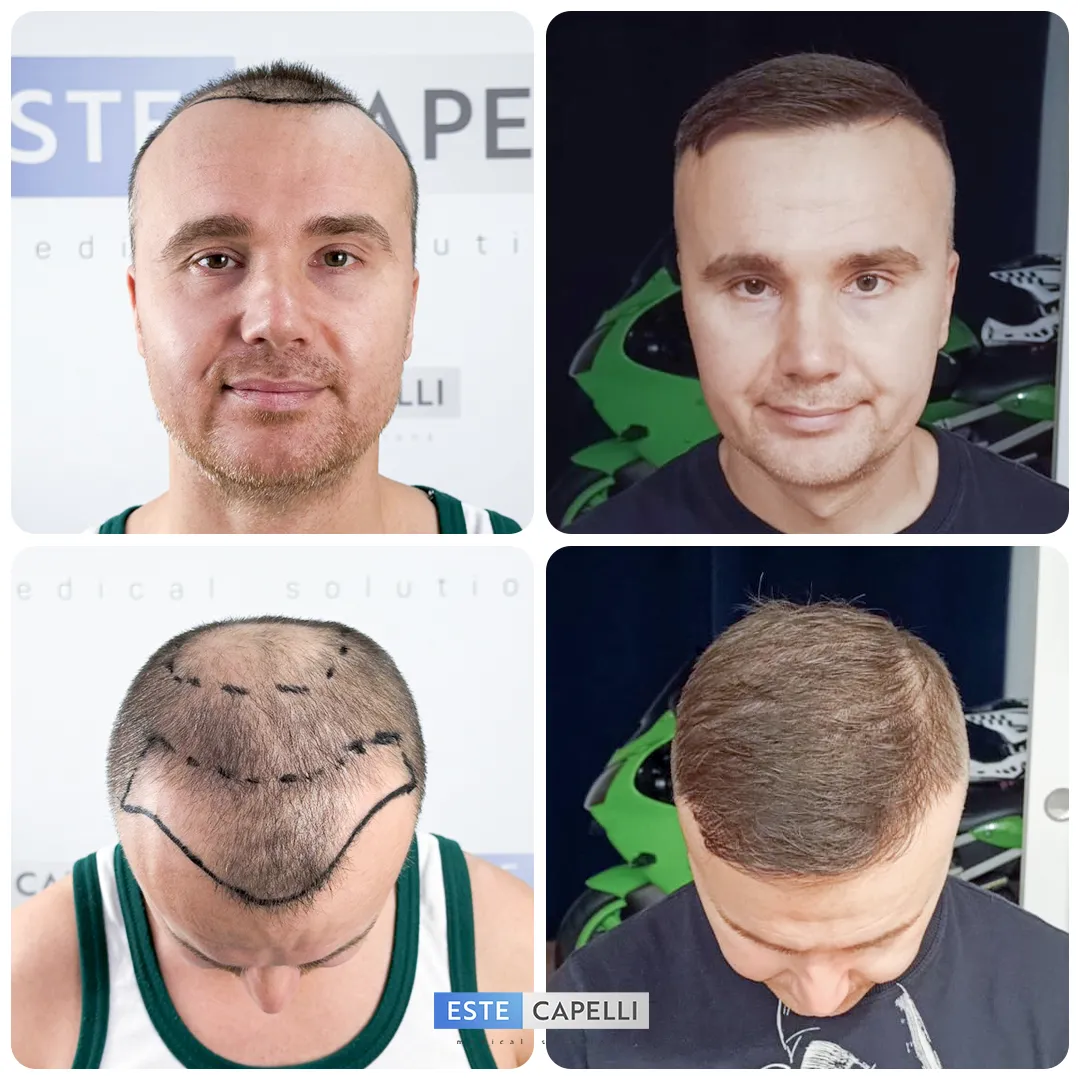 Before and after result