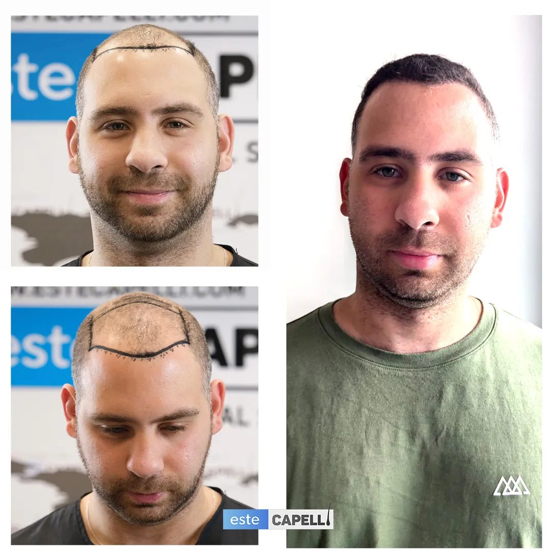 Before and after result