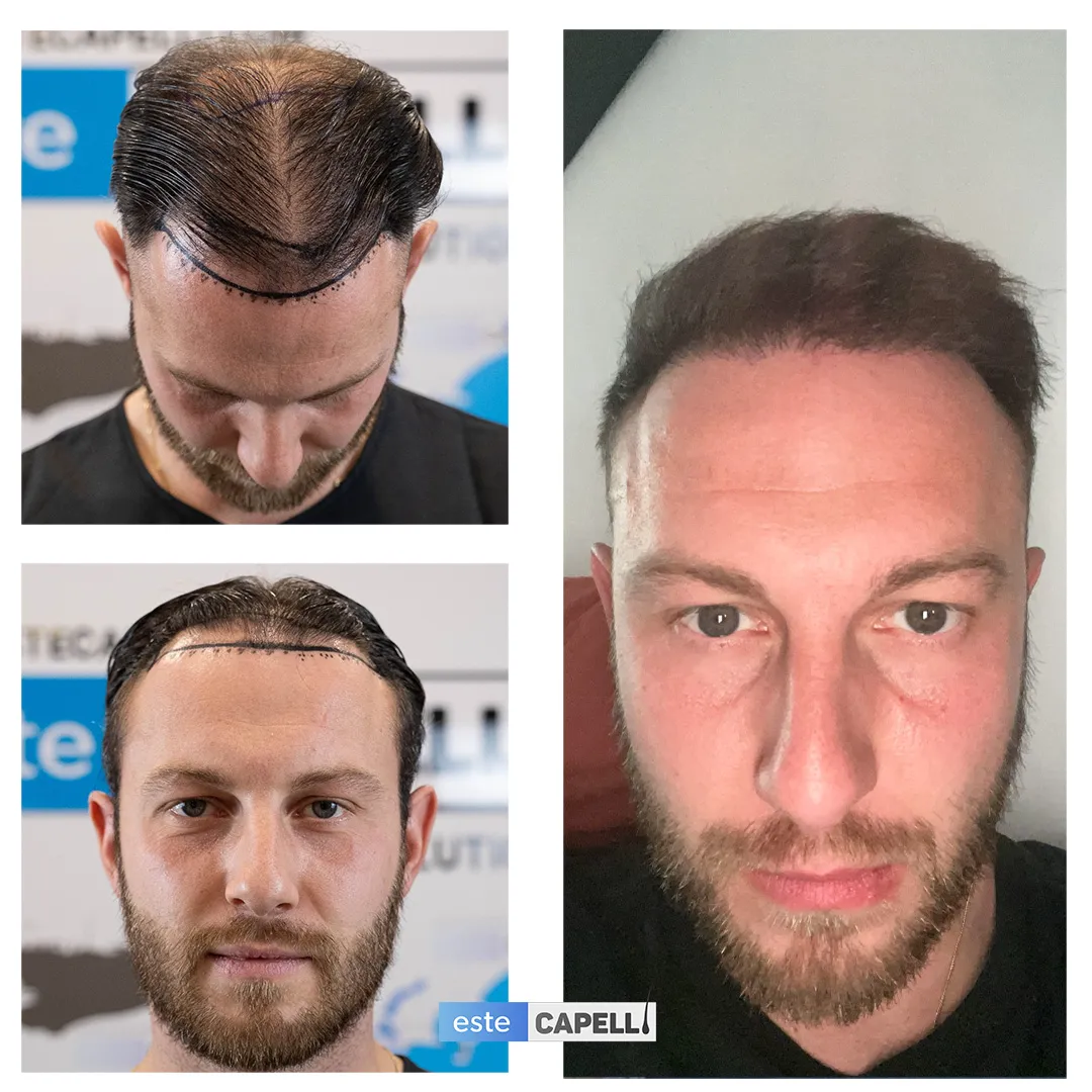 Before and after result