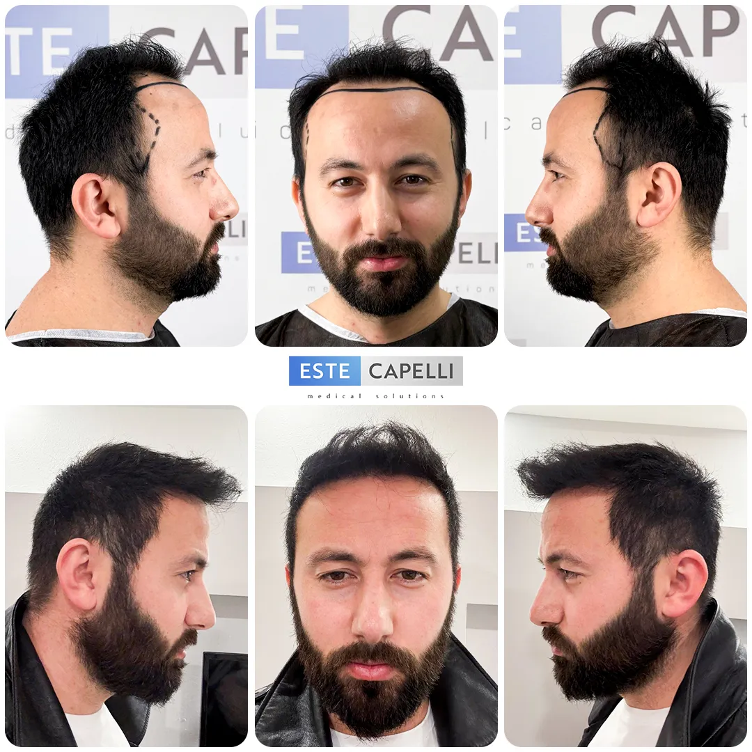 Before and after result