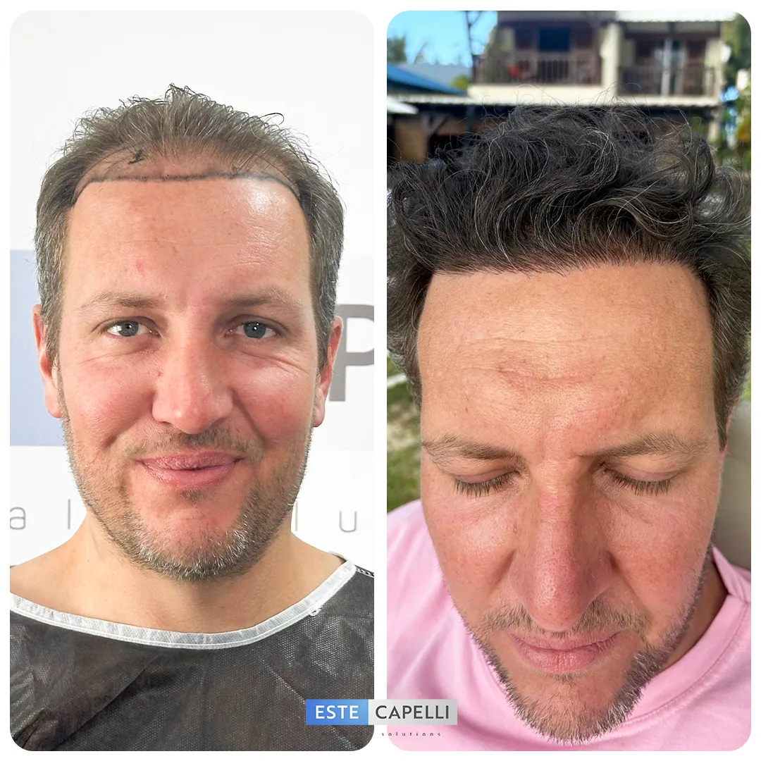 Before and after result