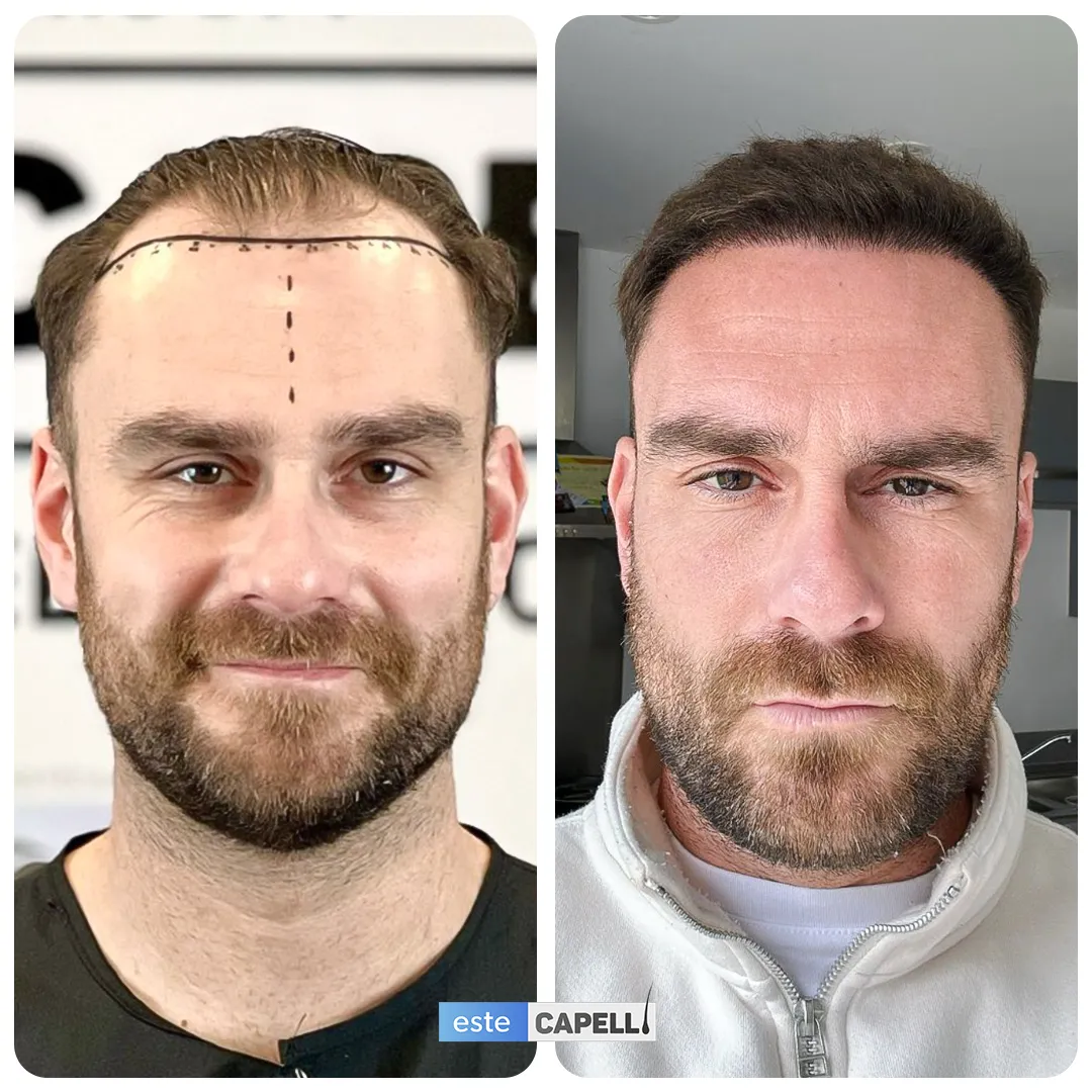 Before and after result