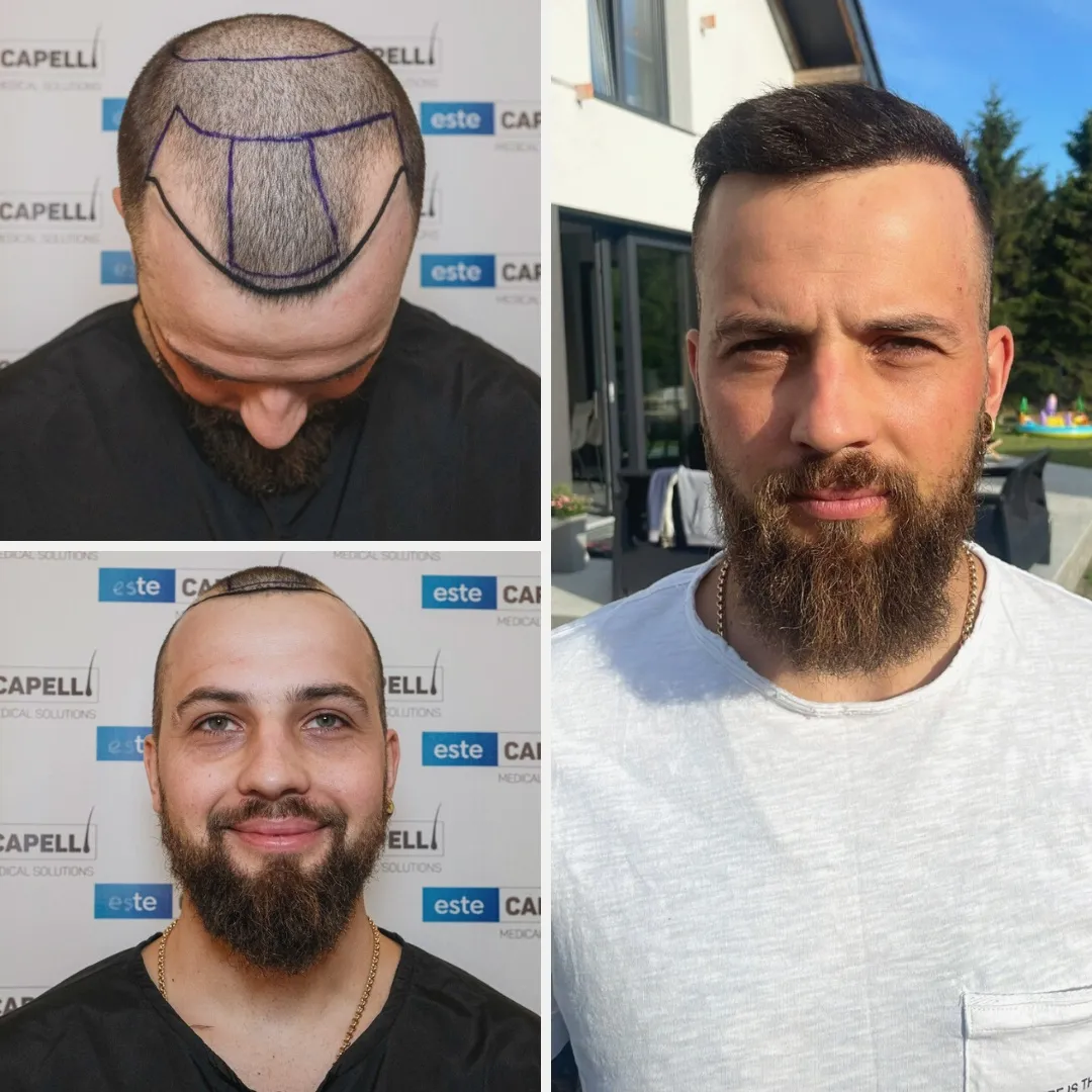 Before and after result